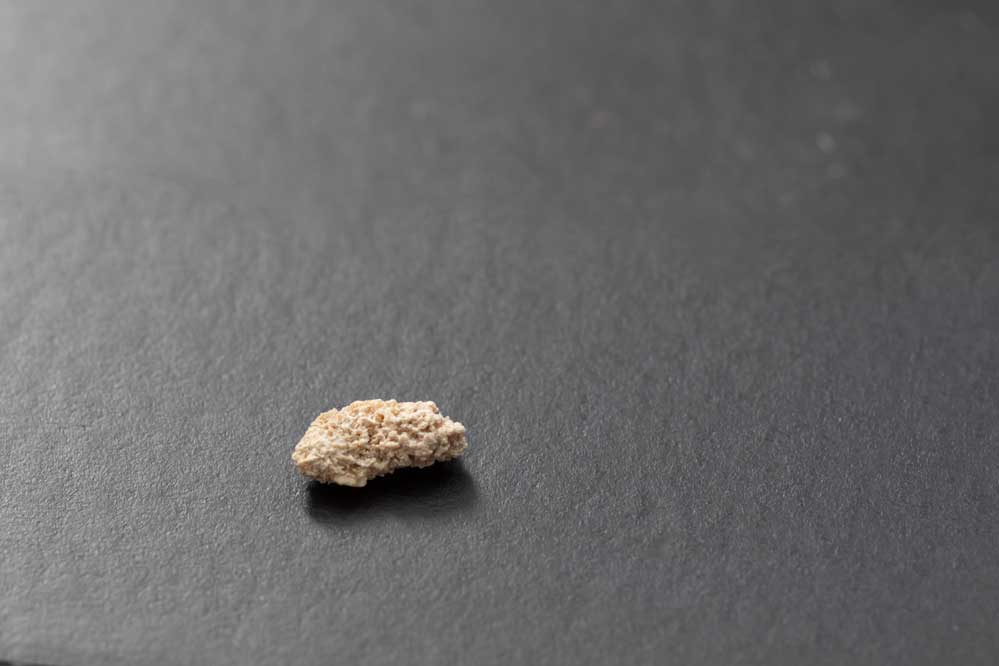 kidney stones on black surface